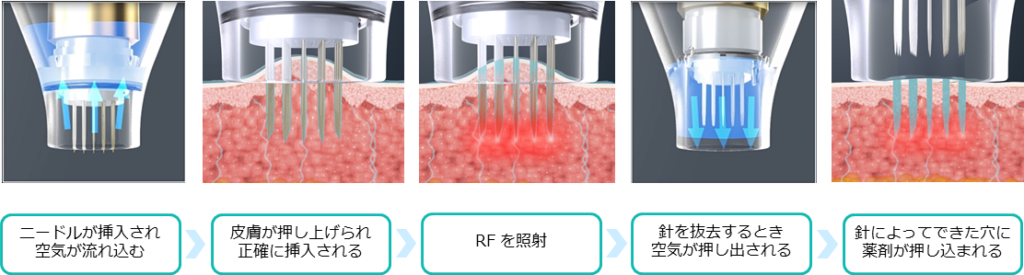 薬剤を均一に浸透させて治療を効果高めるドラッグデリバリーシステム